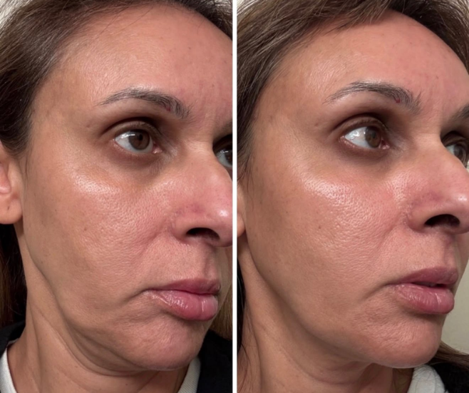 The Beauty Guru Skin Specialist client before and after celebrity non surgical face and neck lift, result 6