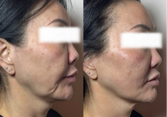 The Beauty Guru Skin Specialist client before and after celebrity non surgical face and neck lift, result 3