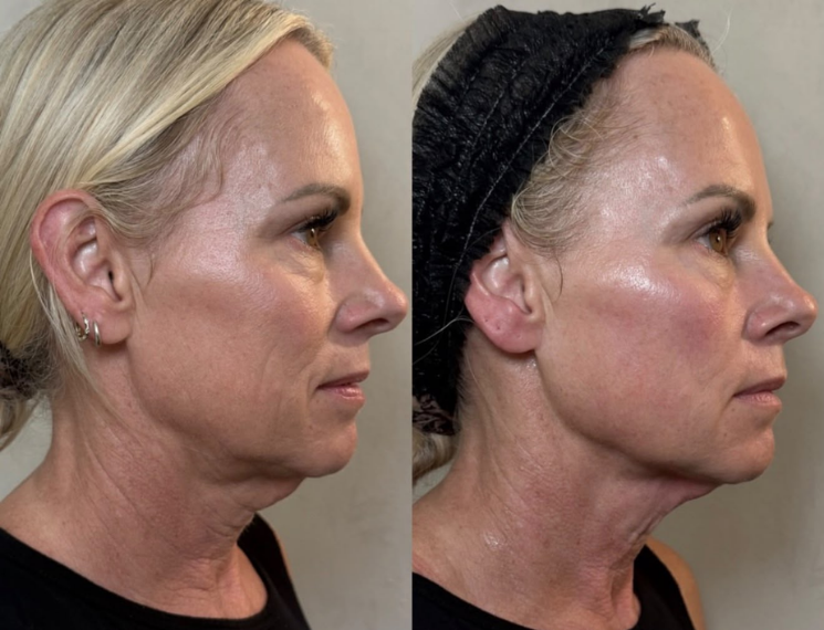 The Beauty Guru Skin Specialist client before and after celebrity non surgical face and neck lift, result 4
