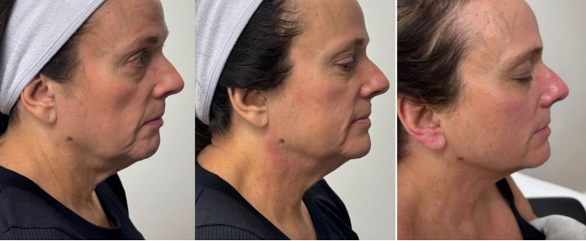 The Beauty Guru Skin Specialist client before and after celebrity non surgical face and neck lift, result 5