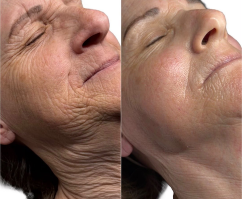The Beauty Guru Skin Specialist client before and after celebrity non surgical face and neck lift, result 2
